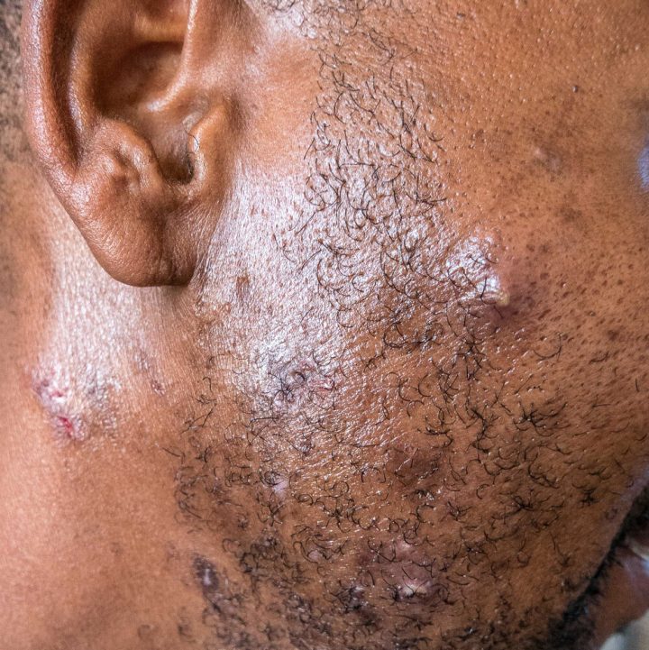 P1010132-46medical,+staphylococcal+skin+infection,+sycosis+barbae